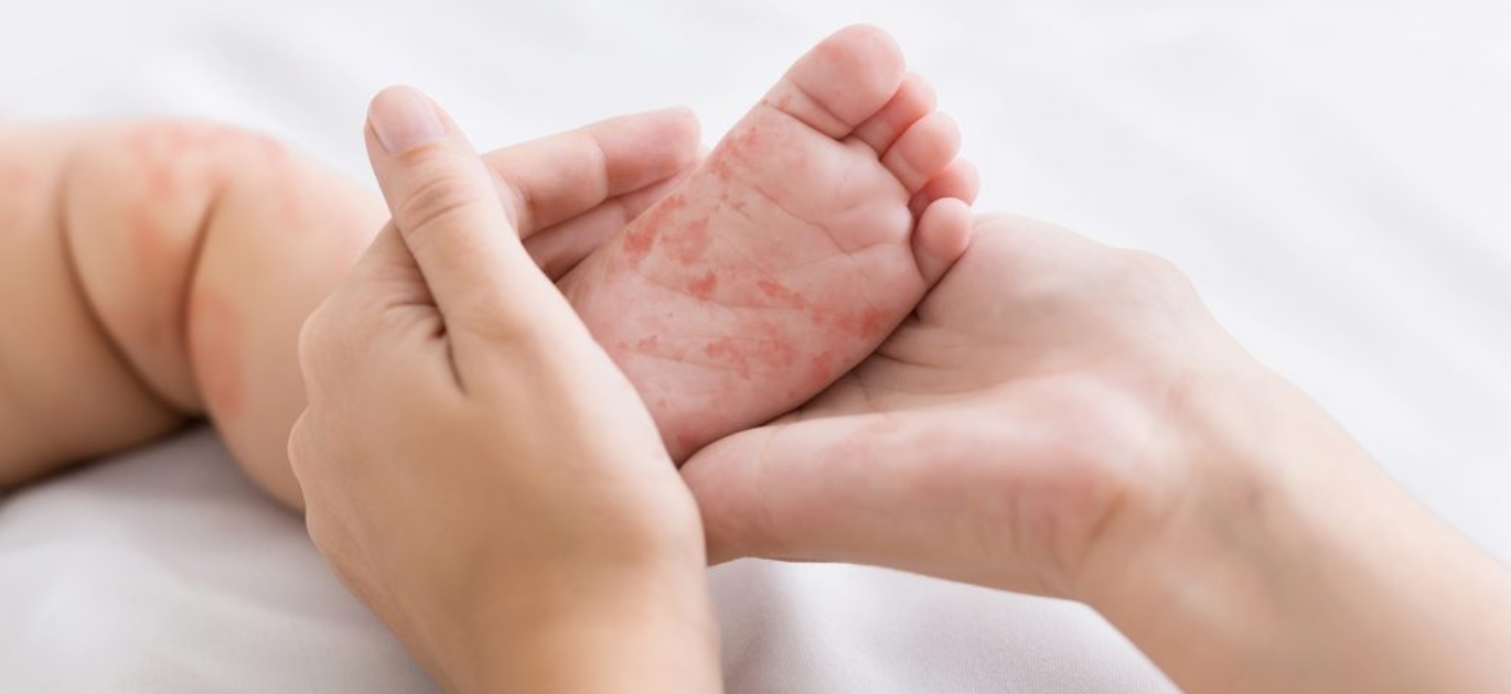 lpa-measles-prevention-02-1024x600